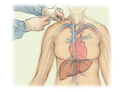 Transjugular Liver Biopsy — The Interventional Initiative