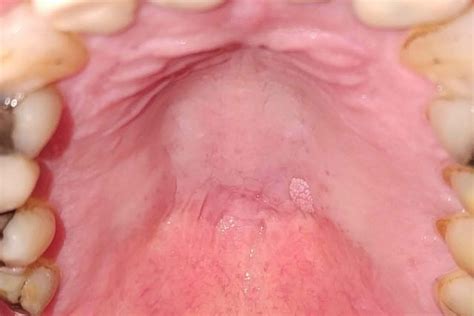 What Does HPV on Your Tongue Look Like?