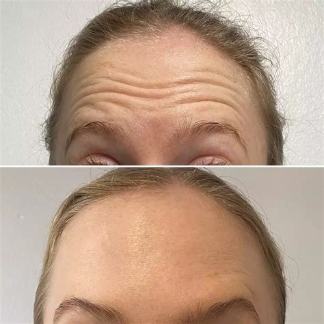 Forehead Lines - Twoth Dental + Facial Aesthetics