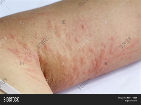 Red Spots Rash On Upper Arm at Eldridge Rucker blog