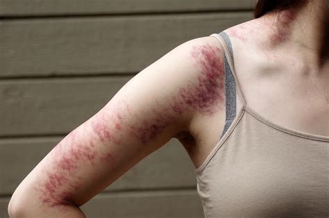 Stress Related Hives On Arms