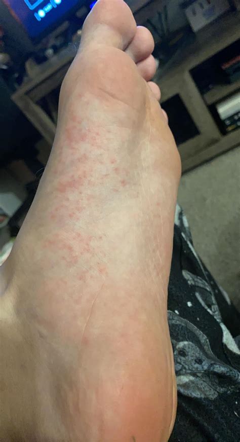 Have had itchy feet in the bottom/middle area of the foot (both feet) for a few days now. Little ...