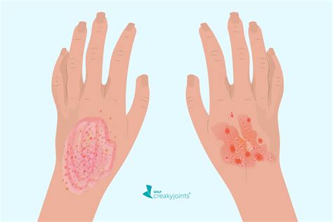 Nummular Eczema Vs Psoriasis Pathology at Sybil Campbell blog