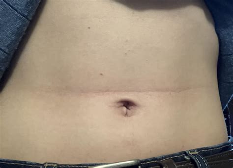 Red line on belly : r/Skincare_Addiction