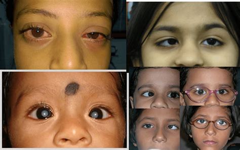Symptoms that show your child needs a paediatric ophthalmologist