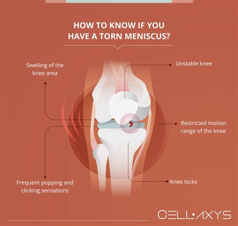 How To Support Knee With Torn Meniscus at Irene Troyer blog