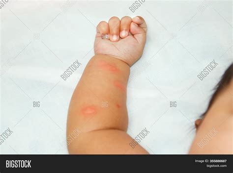 Dengue Mosquito Bite Looks Like