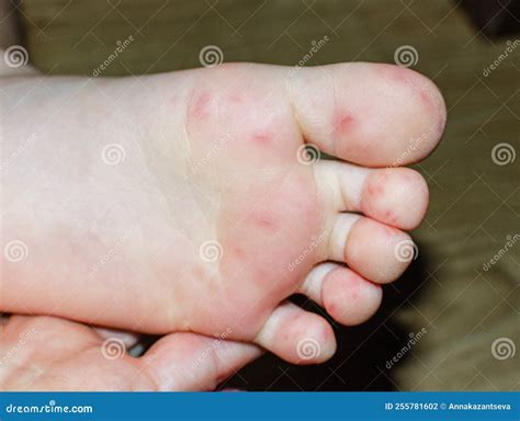 Yellow Foot Rash at Tommy Bautista blog
