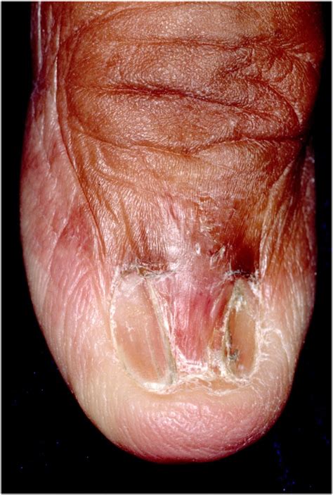 Dermatology images: Lichen planus - Journal of the American Academy of ...