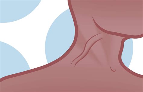 Why Is There A Lump On My Jugular Vein at Timothy Votaw blog
