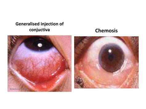 Chemosis Of Conjunctiva