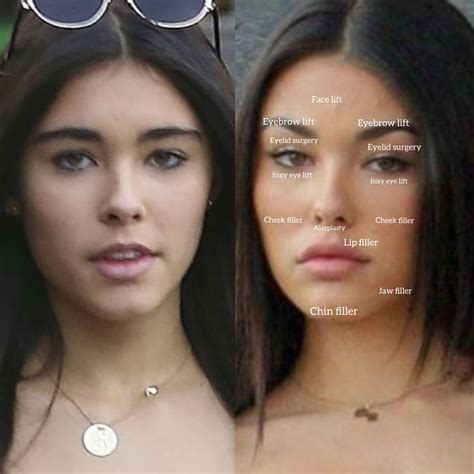 Madison Elle Beer Plastic Surgery | Eyebrow lift, Face surgery, Face fillers