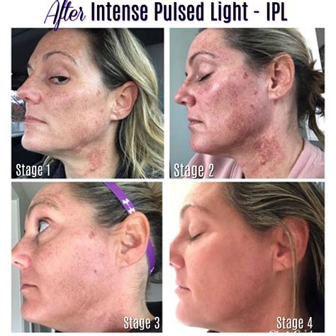 List 103+ Pictures Before And After Pictures Of Laser Skin Resurfacing ...