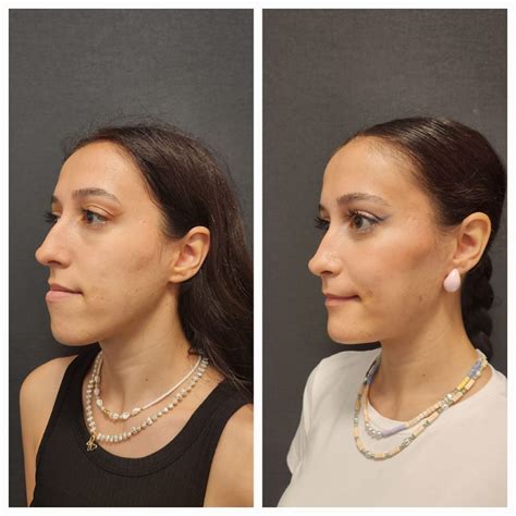 TMJ Surgery Before and After Photos – Prof. Dr. Celal Çandırlı