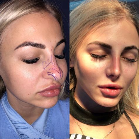 Rhinoplasty Surgery, Nose Surgery, Facial Fillers, Celebrity Plastic Surgery, Big Noses, Lip ...