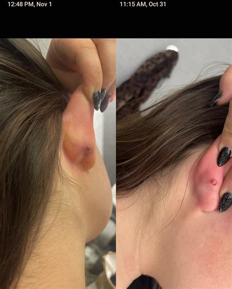 Whats A Piercing Keloid at Lois Horning blog