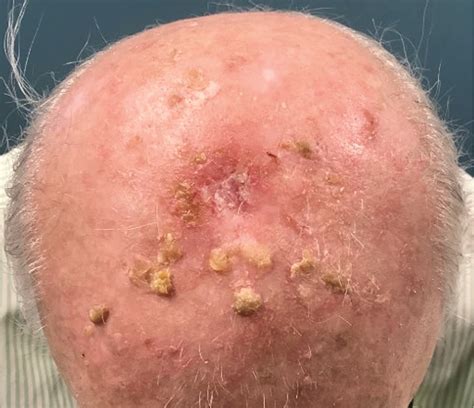 Signs Of Skin Cancer Scalp at Jonathan Landseer blog