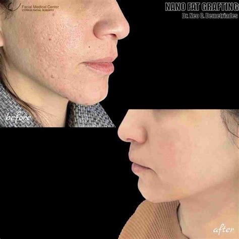 Nano Fat Grafting – Before & After - Cyprus Facial Surgery