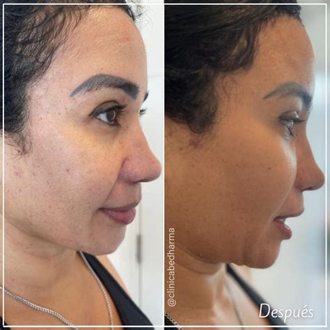 ¿Qué es Melasma? - Clínica Estética en Medellín