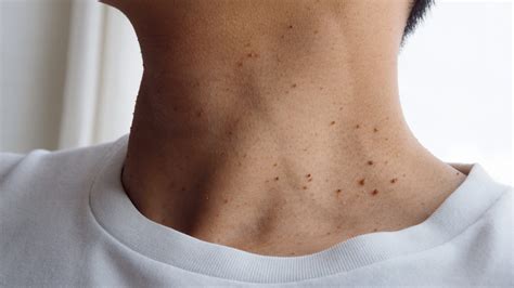 Skin Tags: What Are They & Can They Be Removed? | Duncan Dermatology