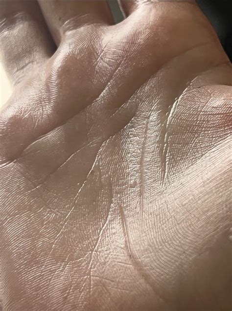 bump on hand : r/DermatologyQuestions