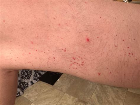 Itchy Red Marks On Legs at Barry Atchison blog