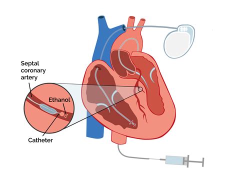 Alcohol Septal Ablation