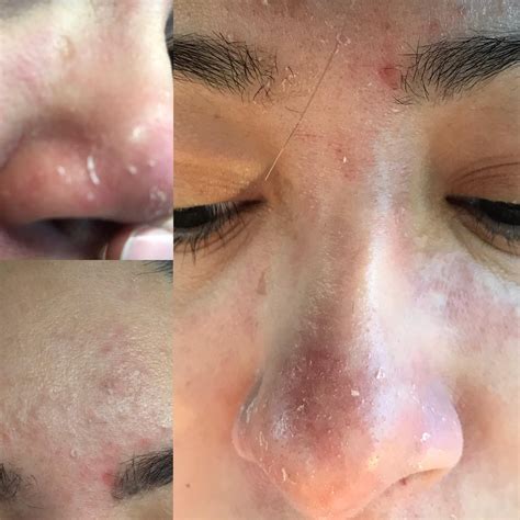 How To Get Rid Of Dry Flaky Skin Around Nose And Mouth at Bobby Mosca blog