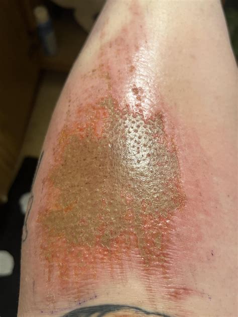 Road rash healing process : r/woundcare