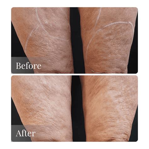 The Best Way To Tighten Loose Skin Without Surgery |Dr Reham