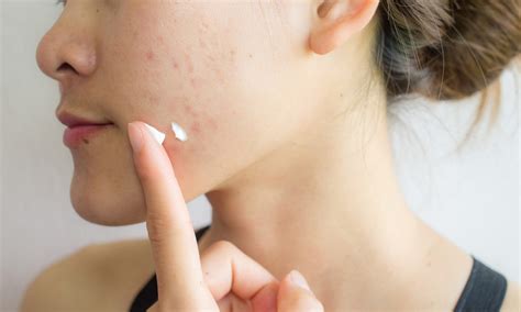 Head and Shoulders for Acne? Experts Warn Against Shampoo Hack