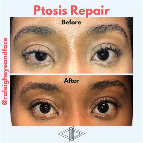 Raleigh Eye and Face Plastic Surgery - Raleigh Eye and Face Plastic Surgery - Serving Raleigh ...