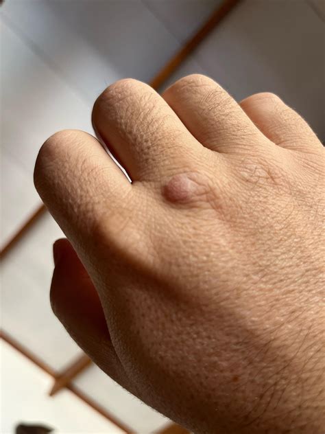 Bump on knuckle : r/DermatologyQuestions