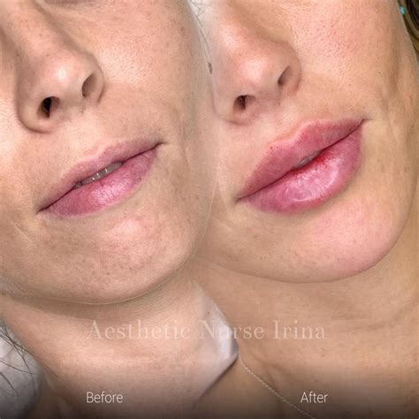 Cosmetic Treatments Before and After Gallery
