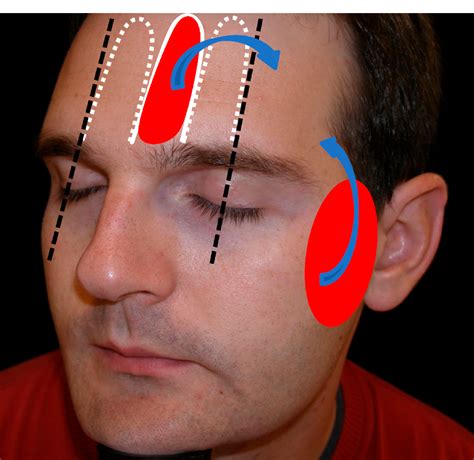 Figure 1 from Simplifying Forehead and Temple Reconstruction: A ...