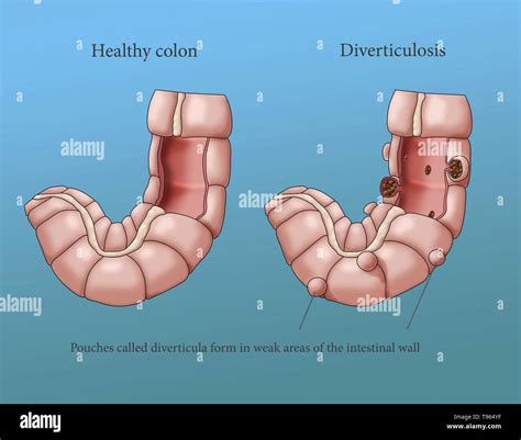 Pickles And Diverticulosis at Norma Plouffe blog