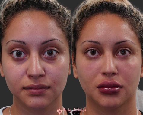 Under Eye Fillers - Before & After Results at Skinly