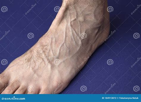 A Man Foot With A Mesh Of Dilated Varicose Veins Stands On A Blue Background Royalty-Free Stock ...