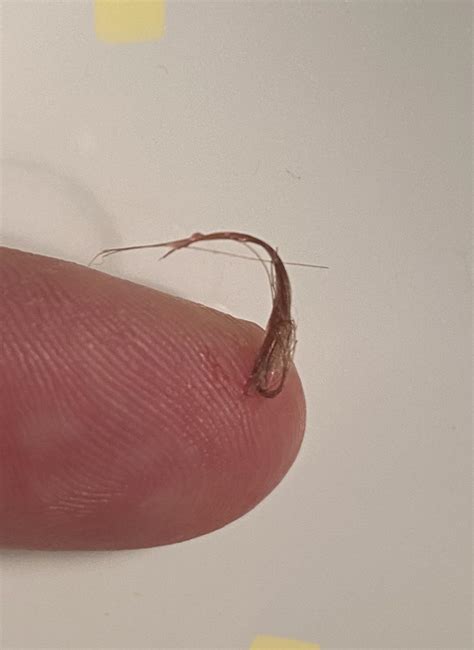 Pilonidal Cyst Contents : popping