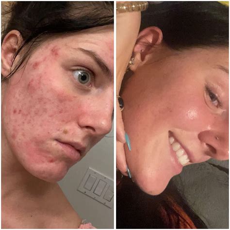 Does Vaping Cause Acne