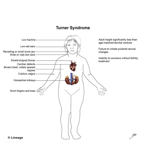 Turner Syndrome - Reproductive - Medbullets Step 1