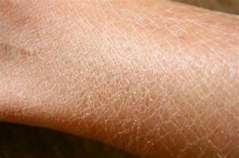 Xerosis Of Skin