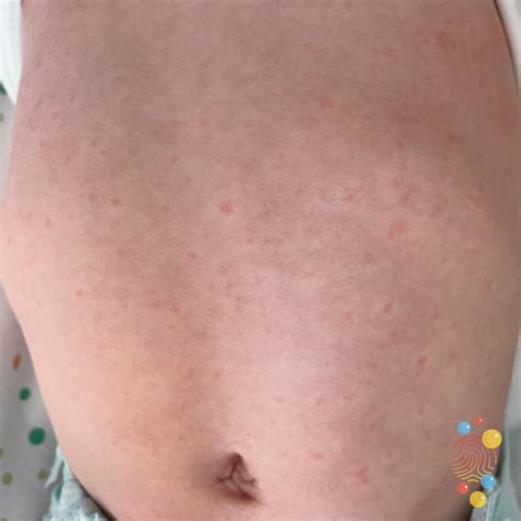 Roseola Infantum Rash Pictures Roseola Bebout Family Medicine