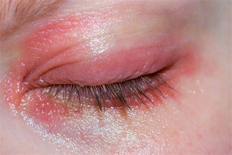 Swollen Eyelid Dermatitis Treatment at Jordan Timperley blog