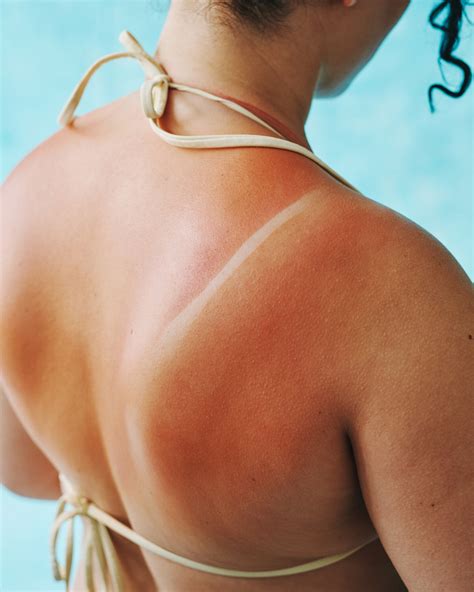 How To Treat Sunburns: Effective Remedies and Prevention Tips ...