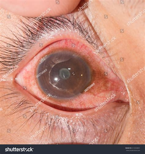 Close Anterior Uveitis Posterior Synechia During Stock Photo 313334831 | Shutterstock