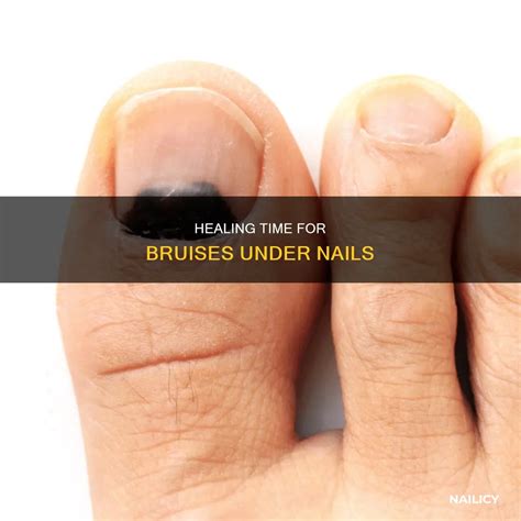 Healing Time For Bruises Under Nails | Nailicy