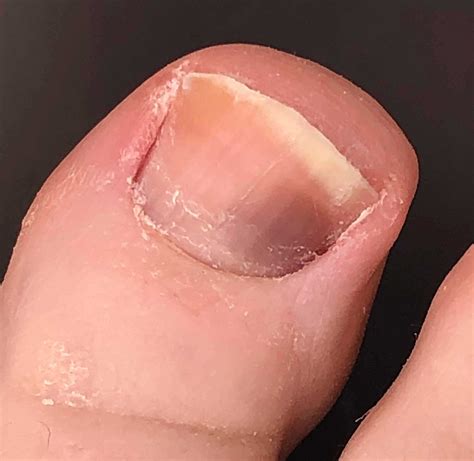 Normal Black Line On Toenail Vs Melanoma at Allyson Byerly blog