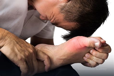 Fast Relief from Gout Flare-Ups: 10 Proven Ways to Take Control