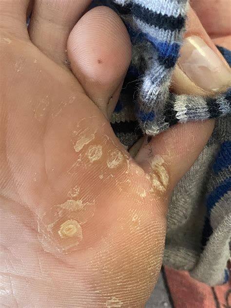 Are these things on my toes warts or calluses? I had treatments done at the derm for the warts ...